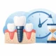 Sa zgjat një implant dentar dhe si ruhet?